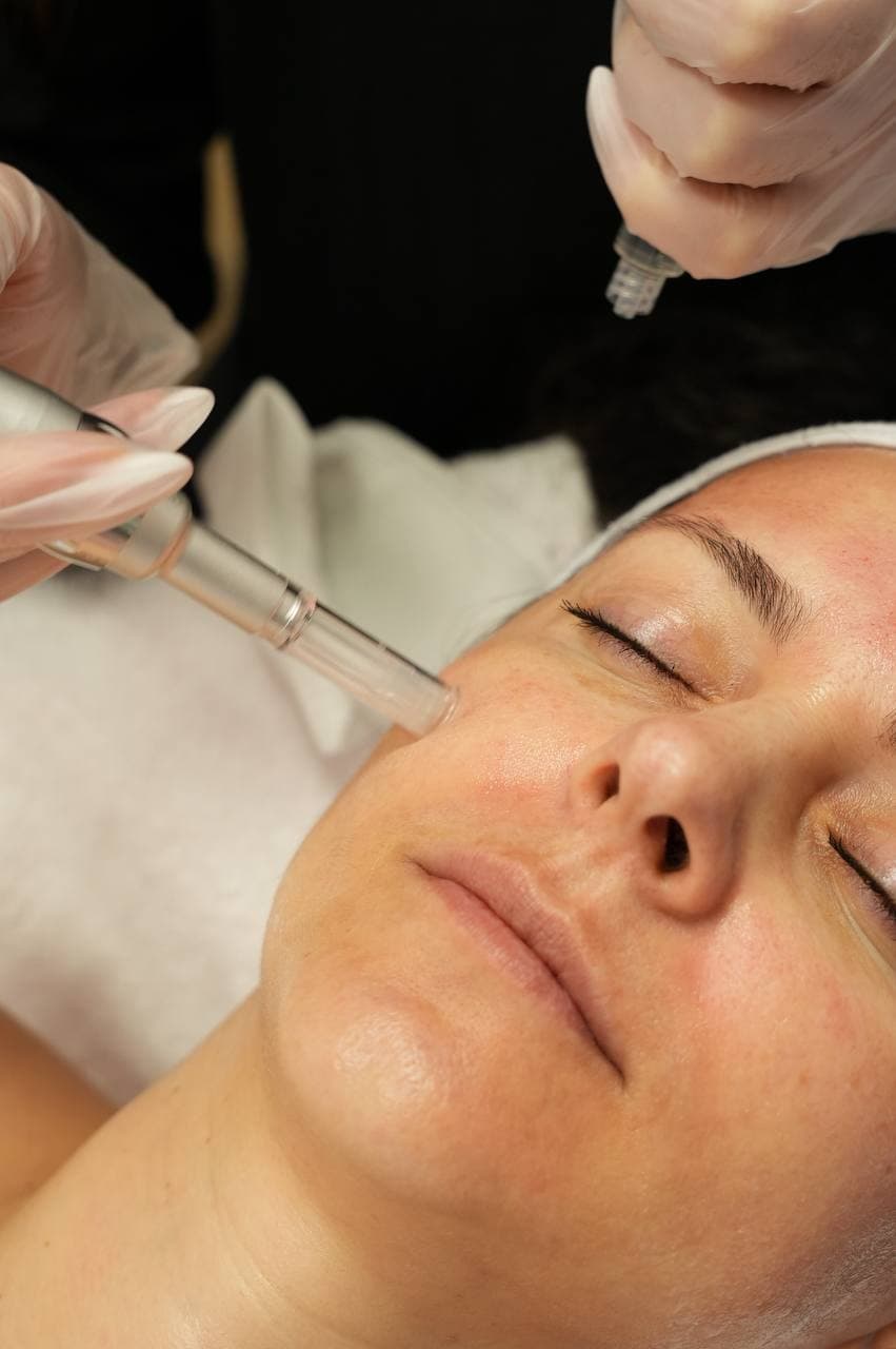 Microneedling